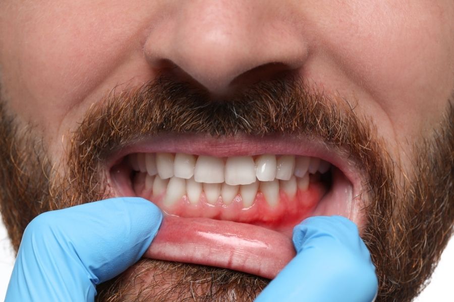 periodontitis-salud-general